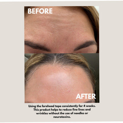Before and after comparison showing a woman's forehead, with visible fine lines and wrinkles on the top 'BEFORE' panel and smoother skin on the bottom 'AFTER' panel. Text below states that using the forehead tape consistently for 4 weeks helps reduce fine lines and wrinkles.
